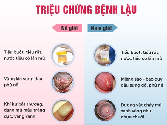 Nhận Biết Dấu Hiệu Mắc Bệnh Lậu Ở Nam Và Nữ