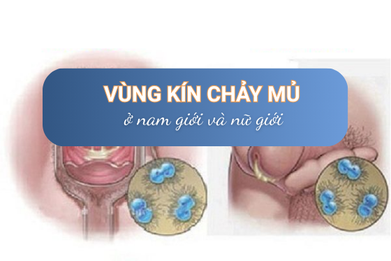 Nguyên Nhân Gây Chảy Mủ Vùng Kín Ở Nam Và Nữ